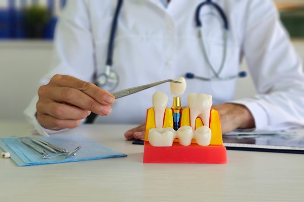 What Is A Dental Crown And When Do You Need One?